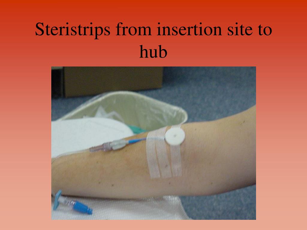 PPT PICC and Midline Catheters PowerPoint Presentation, free download