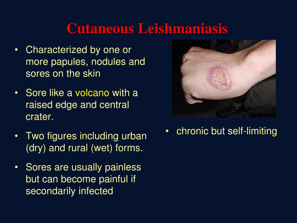 Ppt Leishmaniasis Powerpoint Presentation Free Download Id