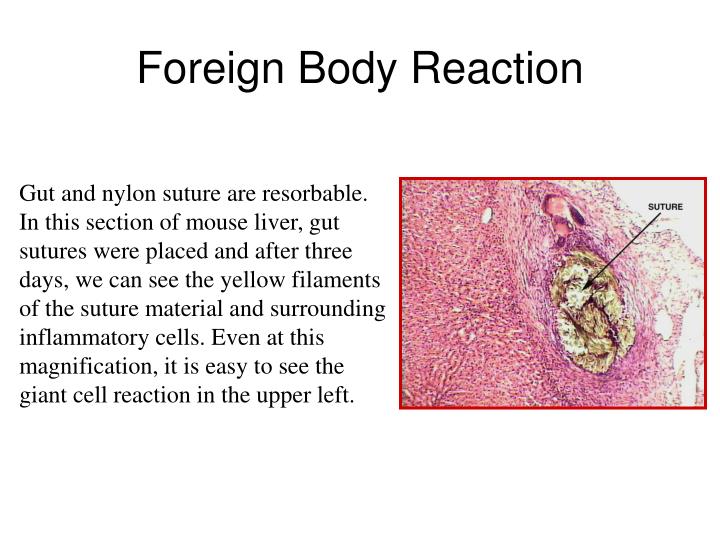 ppt-periapical-granuloma-powerpoint-presentation-id-4604077