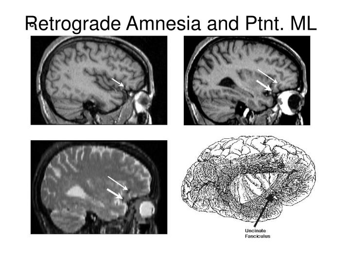 retrograde amnesia