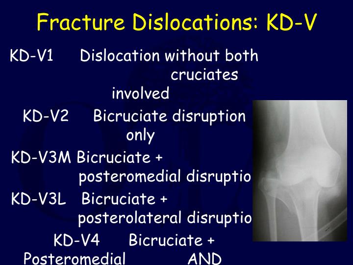 PPT Knee Dislocation and Multiligamentous Injury PowerPoint