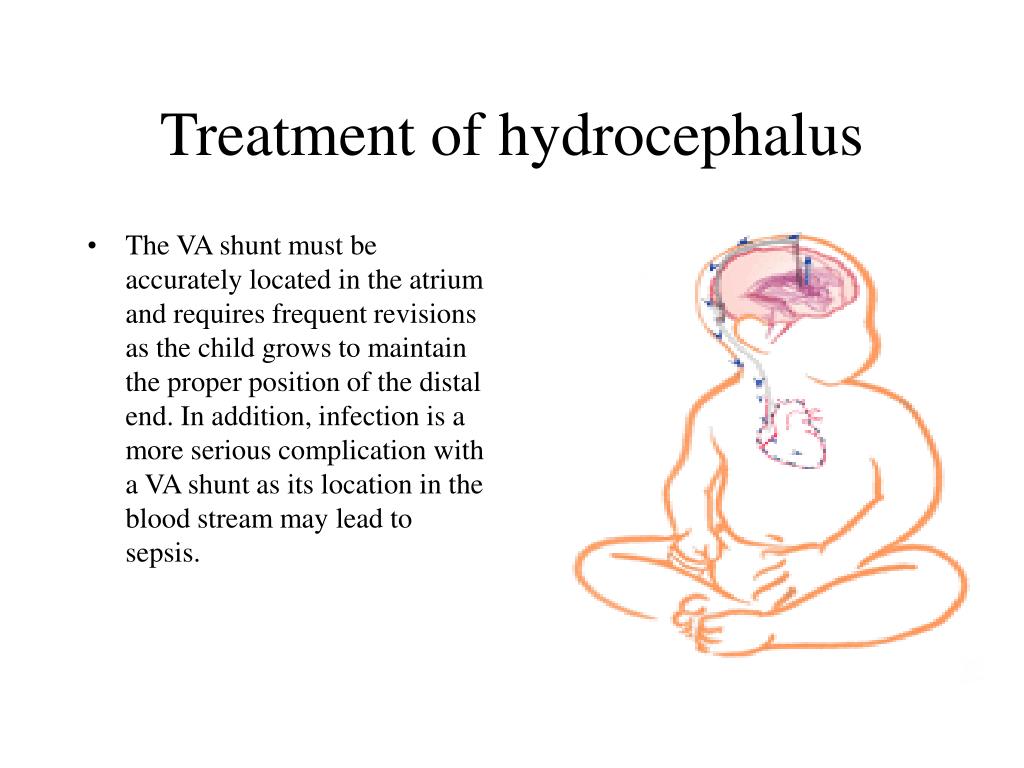 Ppt Hydrocephalus Powerpoint Presentation Free Download Id4628530