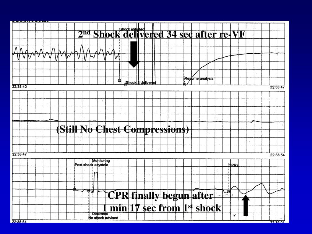 compression to ventilation ratio compression to ventilation ratio