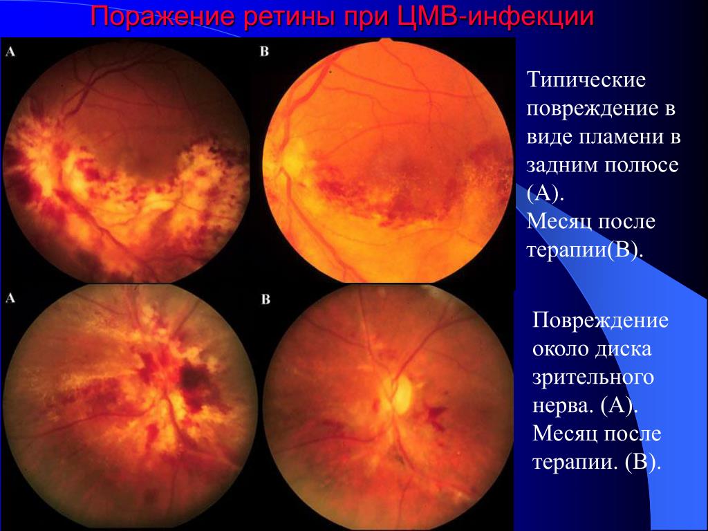Воспаление сетчатки. Ретинопатия хориоретинит. Цитомегаловирус ретинит. Цитомегаловирусный хориоретинит.