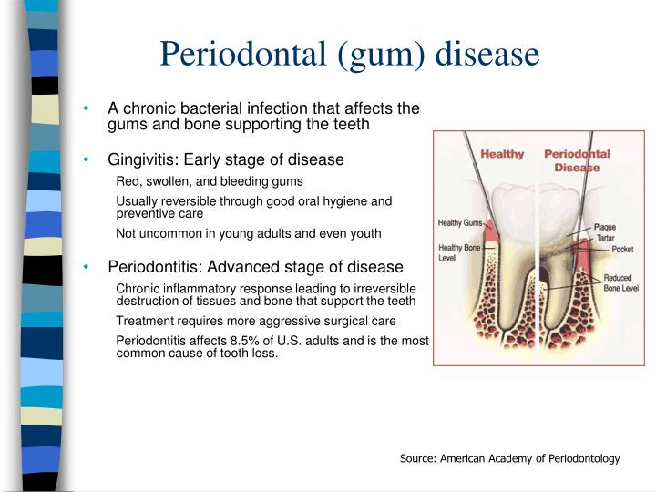 stress depression and periodontal disease essay Mental stress, coping behaviors and social factors all play a role in the relationship between stress and periodontal disease grossi et al 67, 68 conducted an epidemiological risk factor study of the relationship between psychosocial stress, measures of distress, and coping behaviors utilizing self-administered questionnaires. stress depression and periodontal disease essay Mental stress, coping behaviors and social factors all play a role in the relationship between stress and periodontal disease grossi et al 67, 68 conducted an epidemiological risk factor study of the relationship between psychosocial stress, measures of distress, and coping behaviors utilizing self-administered questionnaires.