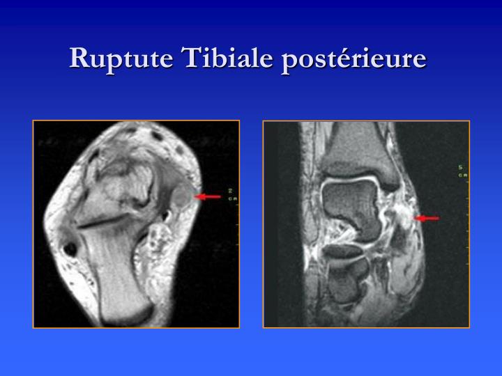 Fissuration Longitudinale Du Tendon Court Fibulaire Traitement