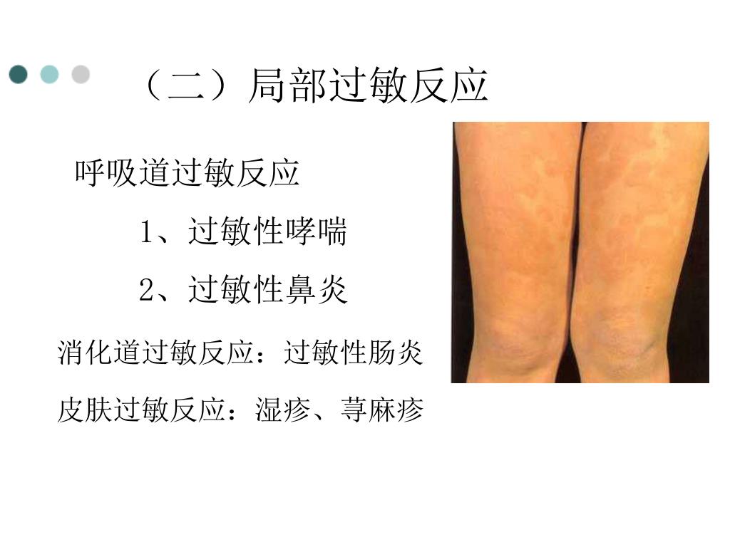 Ppt 第七章超敏反应powerpoint Presentation Free Download Id