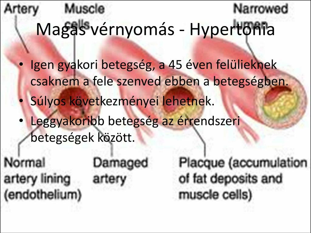 a ccc hipertónia betegségei)