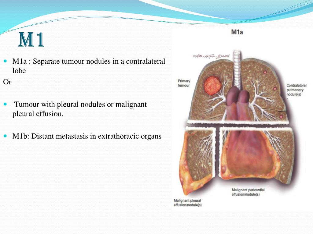 PPT Lung Cancer Staging PowerPoint Presentation Free Download ID 