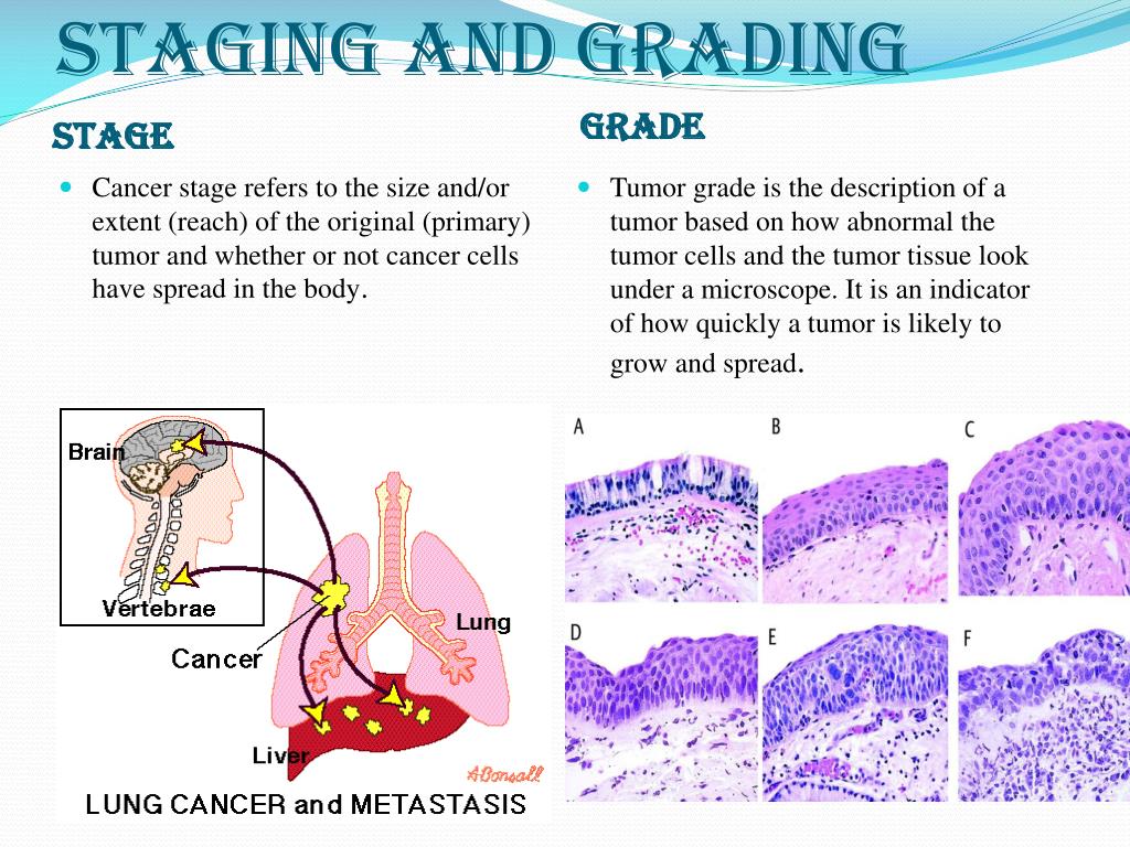 Stages of cancer. Карцинома.граде.1.