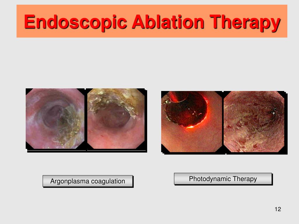 PPT - Novel developments Radiofrequency Ablation (RFA) for dysplastic ...