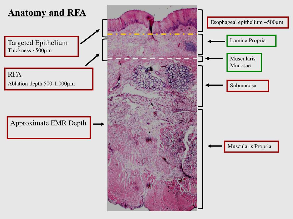 PPT - Novel developments Radiofrequency Ablation (RFA) for dysplastic ...