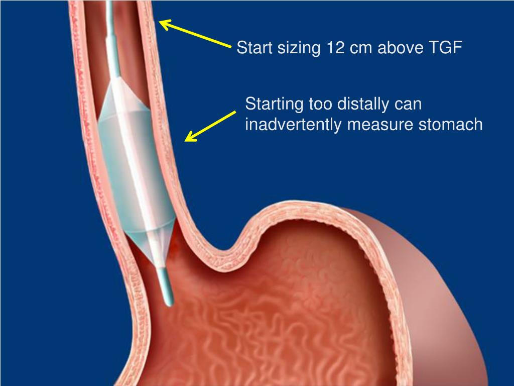 PPT - Novel developments Radiofrequency Ablation (RFA) for dysplastic ...