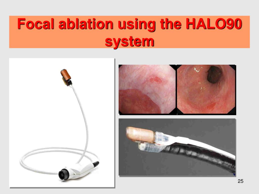 PPT - Novel developments Radiofrequency Ablation (RFA) for dysplastic ...