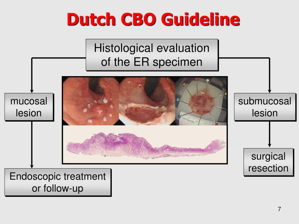 PPT - Novel developments Radiofrequency Ablation (RFA) for dysplastic ...