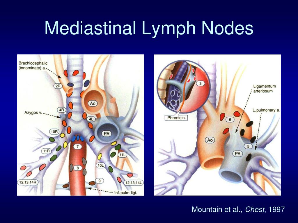 PPT - Mediastinal Staging for Lung Cancer PowerPoint Presentation, free