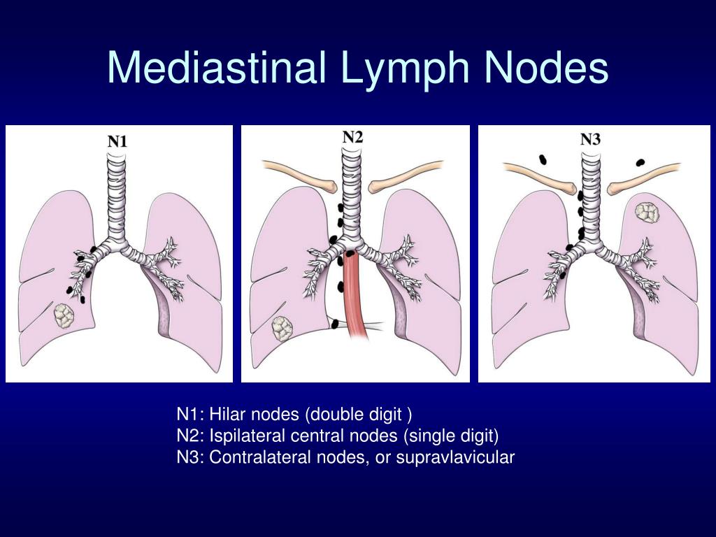 Hilar Lymph Nodes Lung Cancer