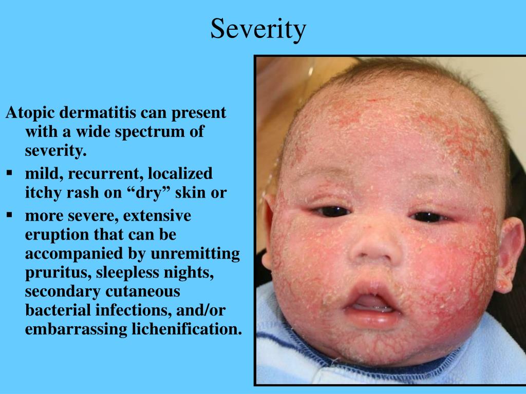 Ppt Atopic Dermatitis Powerpoint Presentation Free Download Id4703850
