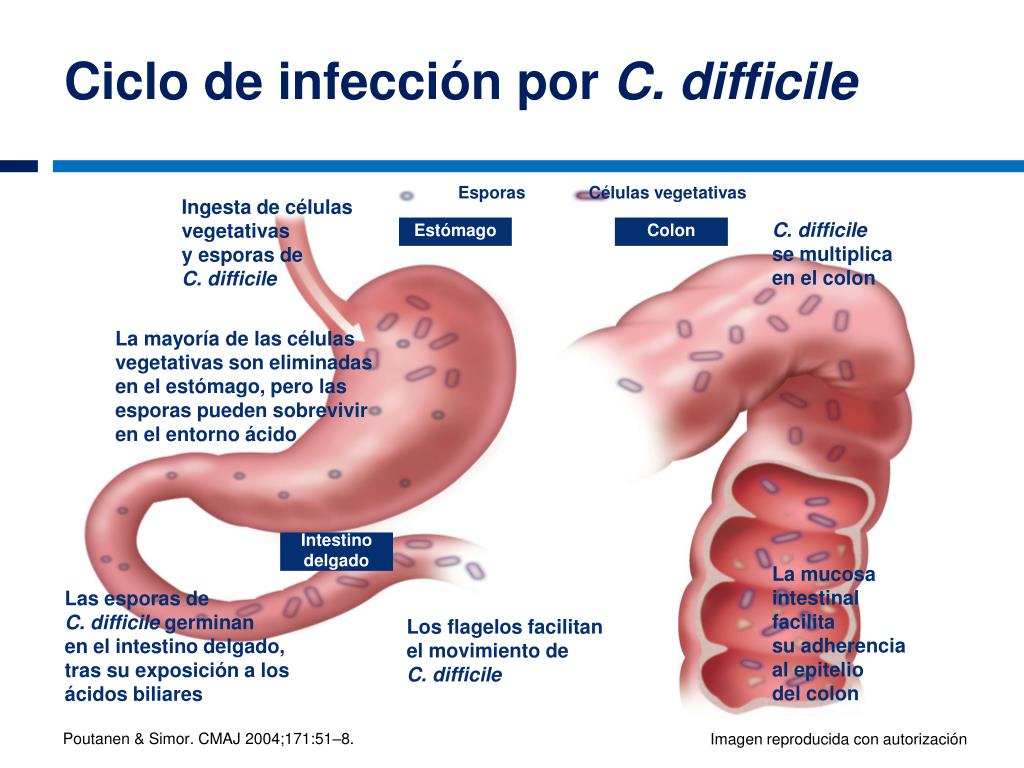 infeccion clostridium