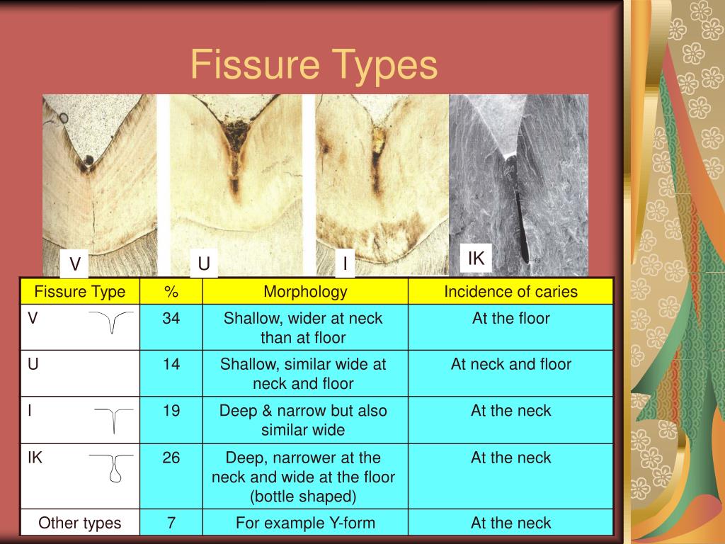 PPT Pit & Fissure Sealing Techniques PowerPoint Presentation ID4726925