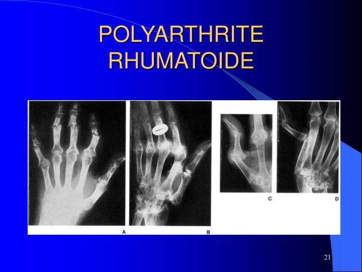 PPT - LES RHUMATISMES INFLAMMATOIRES PowerPoint Presentation - ID:4734688