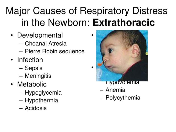 respiratory distress in newborn respiratory distress in newborn
