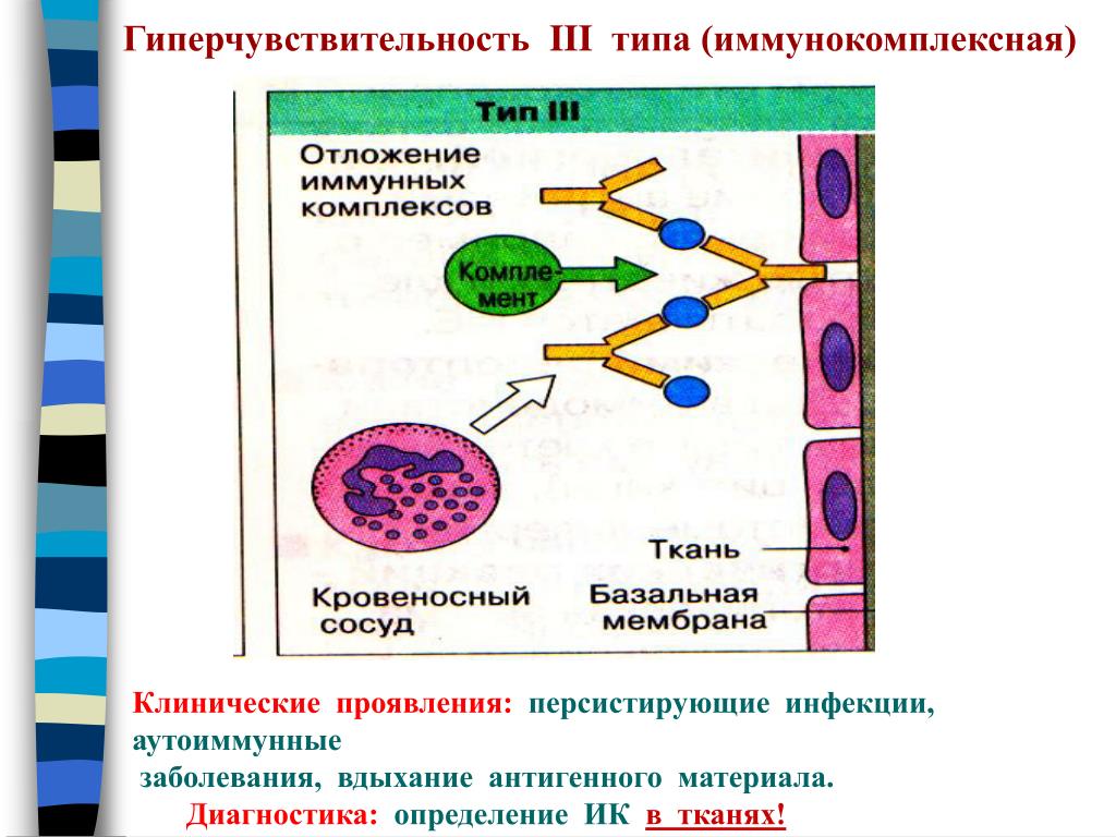 Реакции иммунного повреждения. 3 Тип гиперчувствительности механизм схема. Схема реакции гиперчувствительности 3 типа. Реакция гиперчувствительности 3 типа механизм. Иммунокомплексный Тип гиперчувствительности.