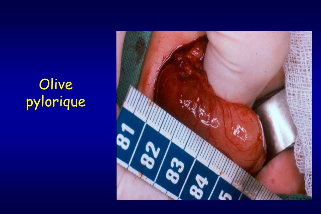 PPT - Vomissements, dysphagie et reflux gastro-oesophagien (nourrisson et  enfant) PowerPoint Presentation - ID:4746192