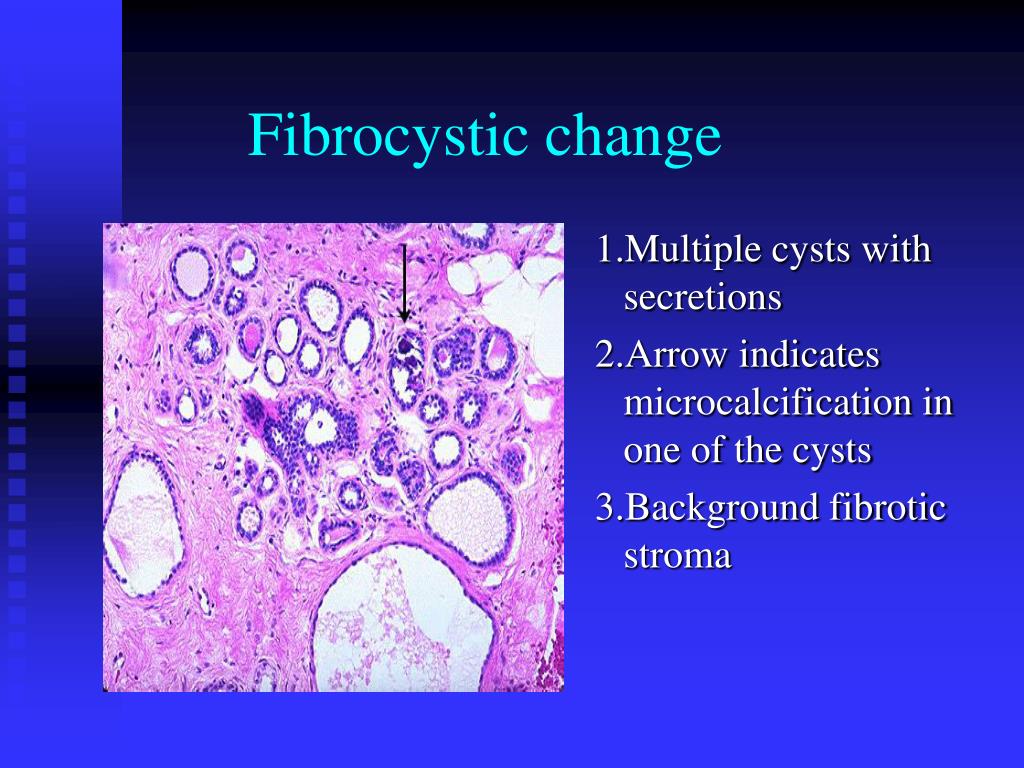 Ppt Breast Pathology Powerpoint Presentation Free Download Id4750342
