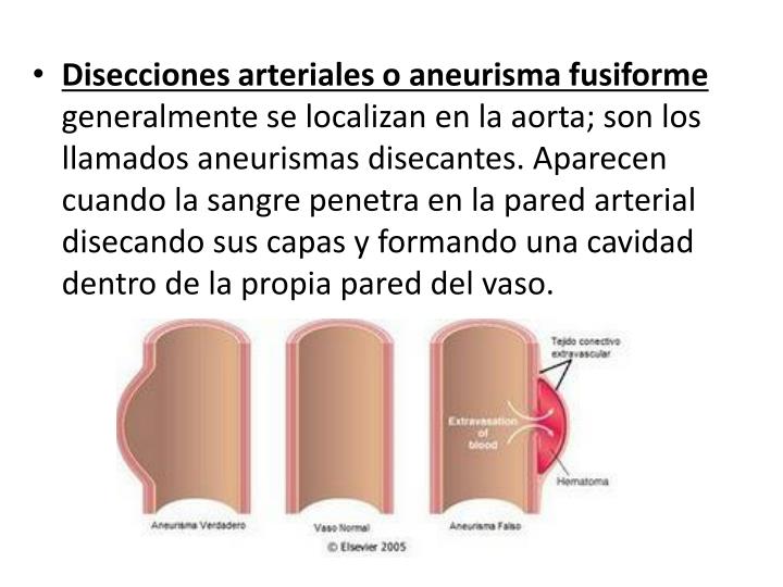 PPT - ANEURISMAS PowerPoint Presentation - ID:4756455