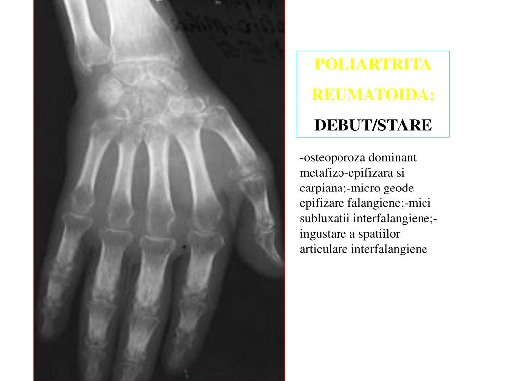 Osteoartroza articulațiilor mici ale tratamentului cu perie, Articol – Totuleaici