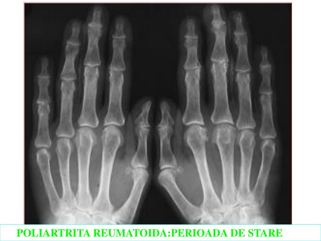 artroza periilor articulațiilor mici articulațiile degetului mic pe braț rănit