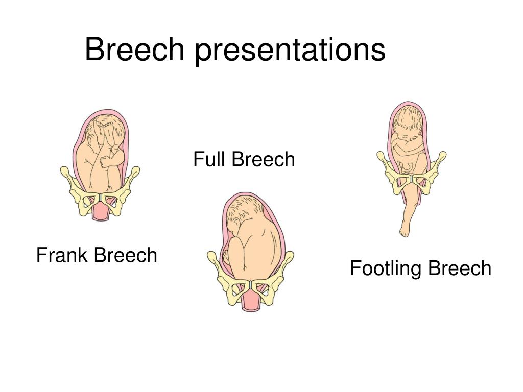 presentation of frank breech