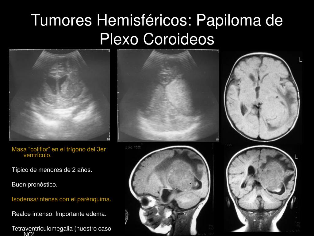 tumor papiloma de plexos coroideos