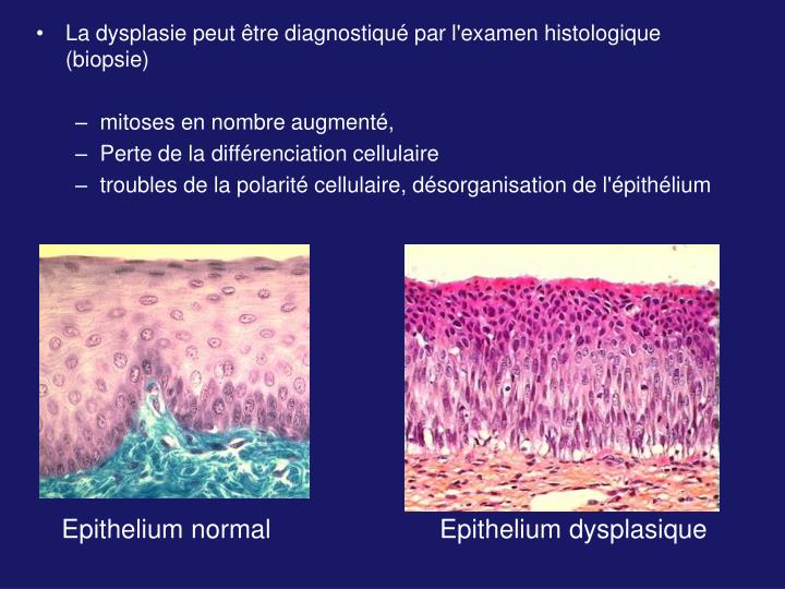 Lesion Epidermoide Intra Epitheliale De Bas Grade