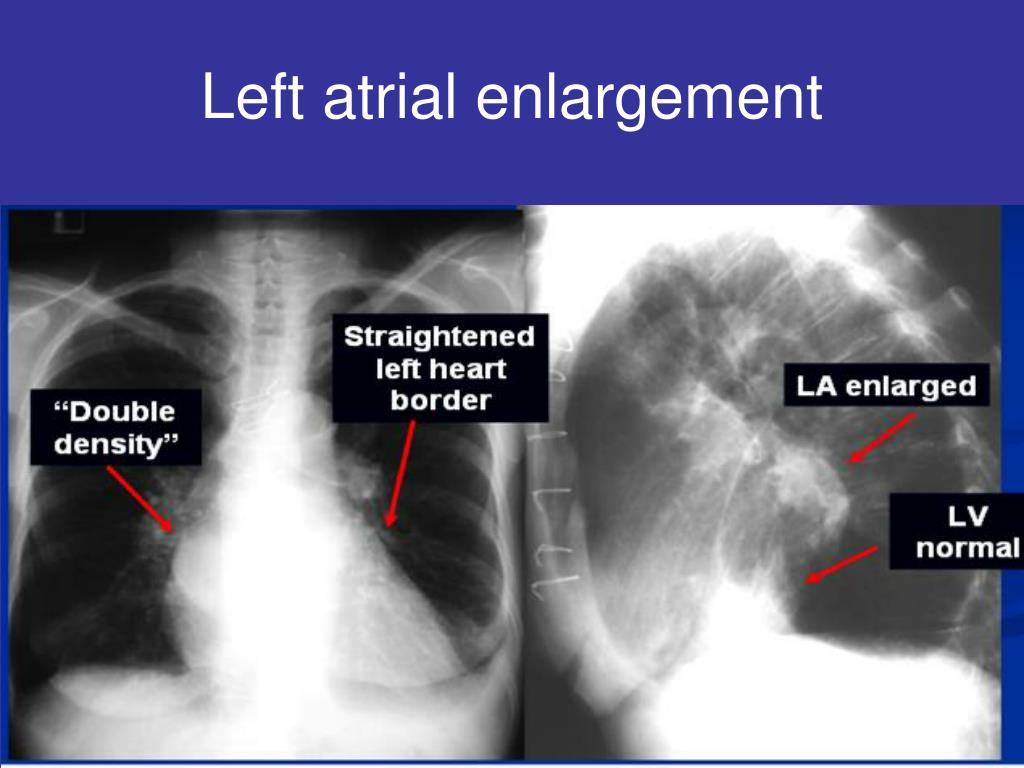 PPT - Normal chest X-ray PowerPoint Presentation, free download - ID