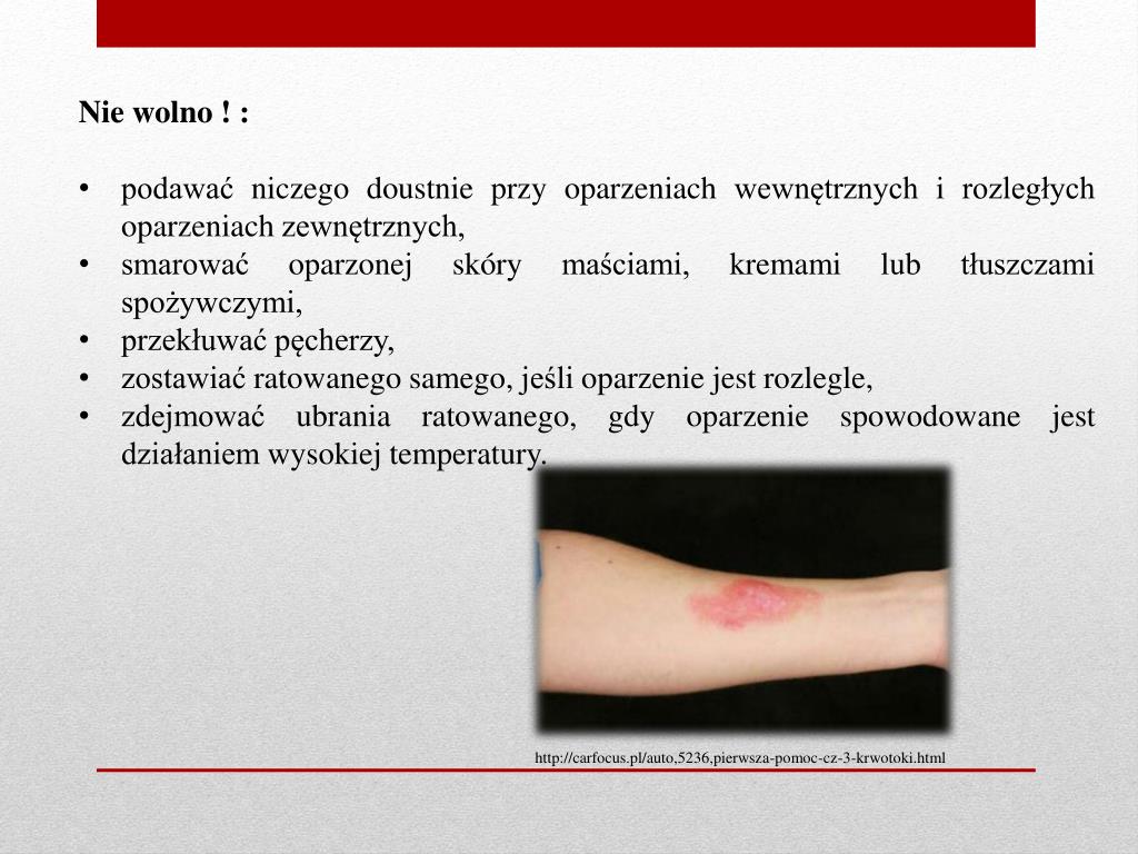 Czy Wolno Ci Polewać Oparzenie Zimną Wodą PPT - PIERWSZA POMOC PowerPoint Presentation, free download - ID:4772273