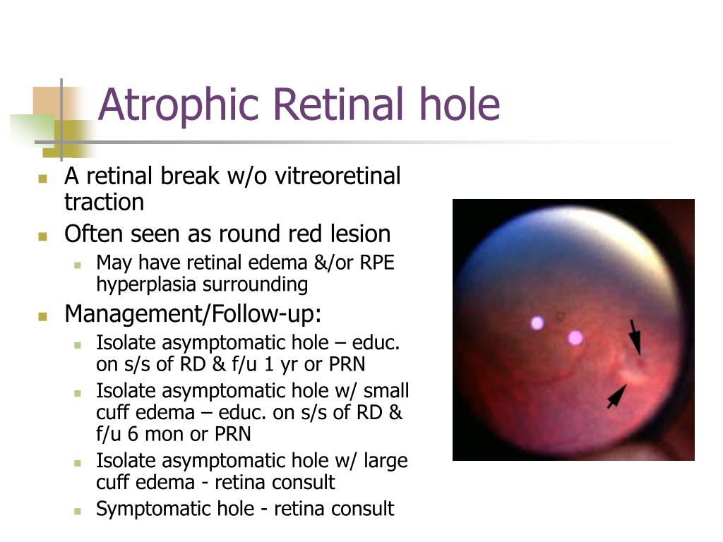 Atrophic Retinal Hole Atrophic Retinal Hole