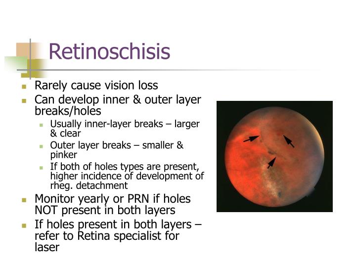 PPT Vitreous & Peripheral Retinal Anomalies PowerPoint Presentation