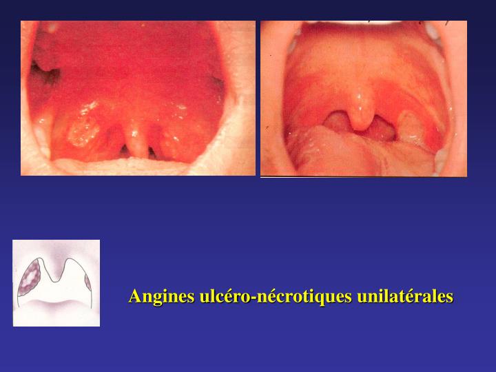 PPT - Les Angines : Étiologies, Diagnostic, Évolution PPT - Les Angines : Étiologies, Diagnostic, Évolution