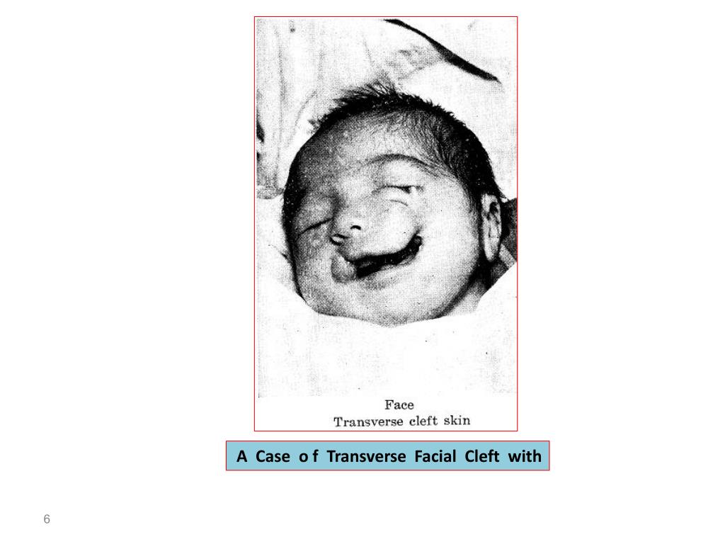 transverse facial cleft