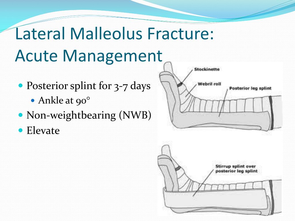 medial malleolus avulsion fracture medial malleolus avulsion fracture