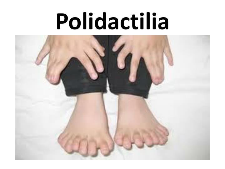 Polidactilia