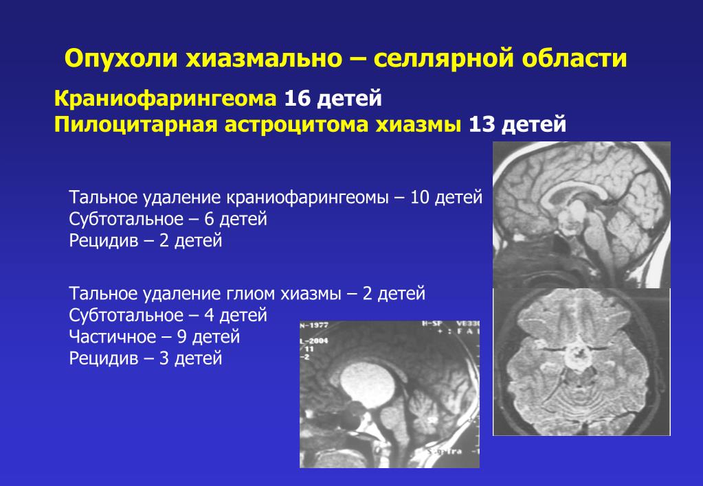 Объемное образование головного мозга мкб 10. Опухоли селлярной области мрт. Патология хиазмально-селлярной области. Объемное образование в хиазмально-селлярной области. Опухоль в области хиазмы.