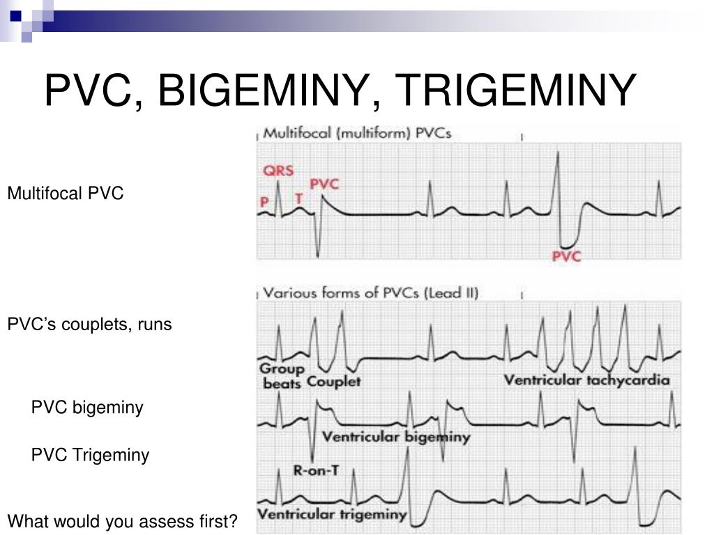 PPT Angina Dysrhythmias PowerPoint Presentation Free Download ID 