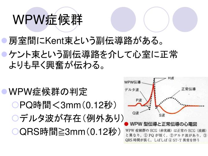 PPT - 心電図勉強会 第 3 回 PQ 時間、 QRS の異常 PowerPoint Presentation - ID:4800852