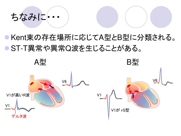 PPT - 心電図勉強会 第 3 回 PQ 時間、 QRS の異常 PowerPoint Presentation - ID:4800852