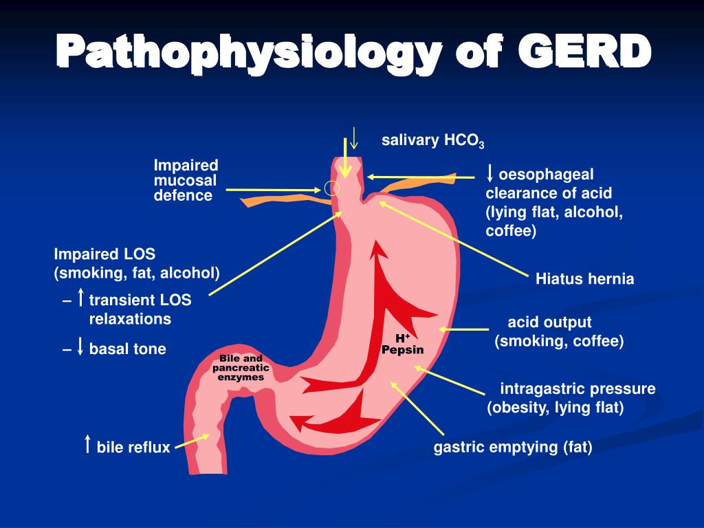 PPT - Gastroesophageal Reflux Disease (GERD) PowerPoint ...