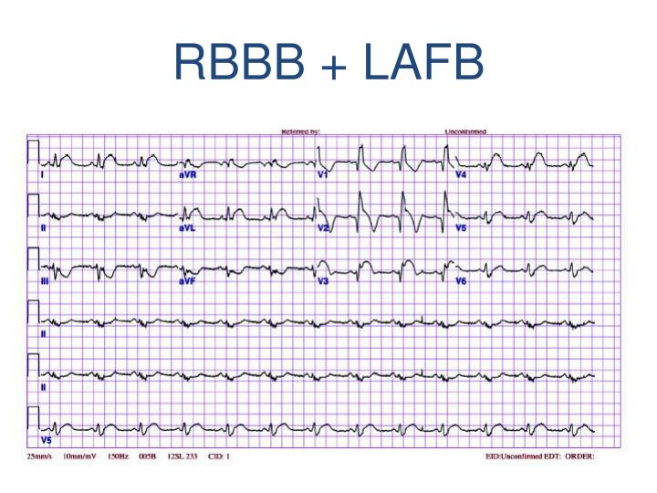 PPT - Bundle Branch Blocks PowerPoint Presentation - ID:4807495