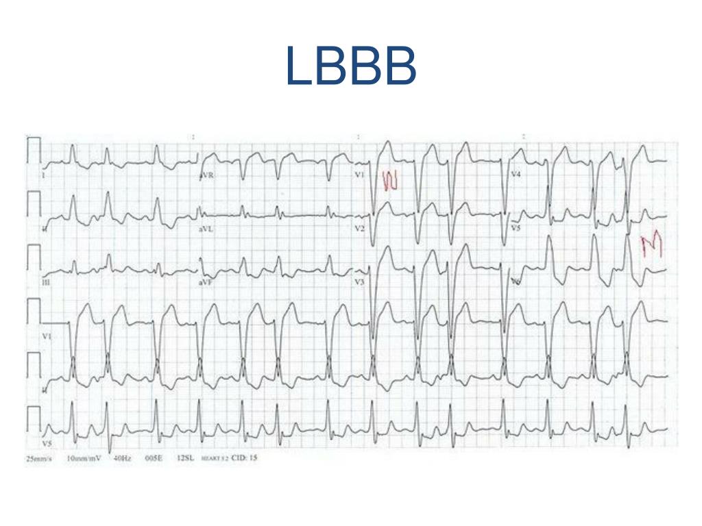 PPT - Bundle Branch Blocks PowerPoint Presentation, free download - ID ...